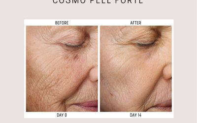 Advanced TCA Chemical Peels in Leeds | Blackabey’s