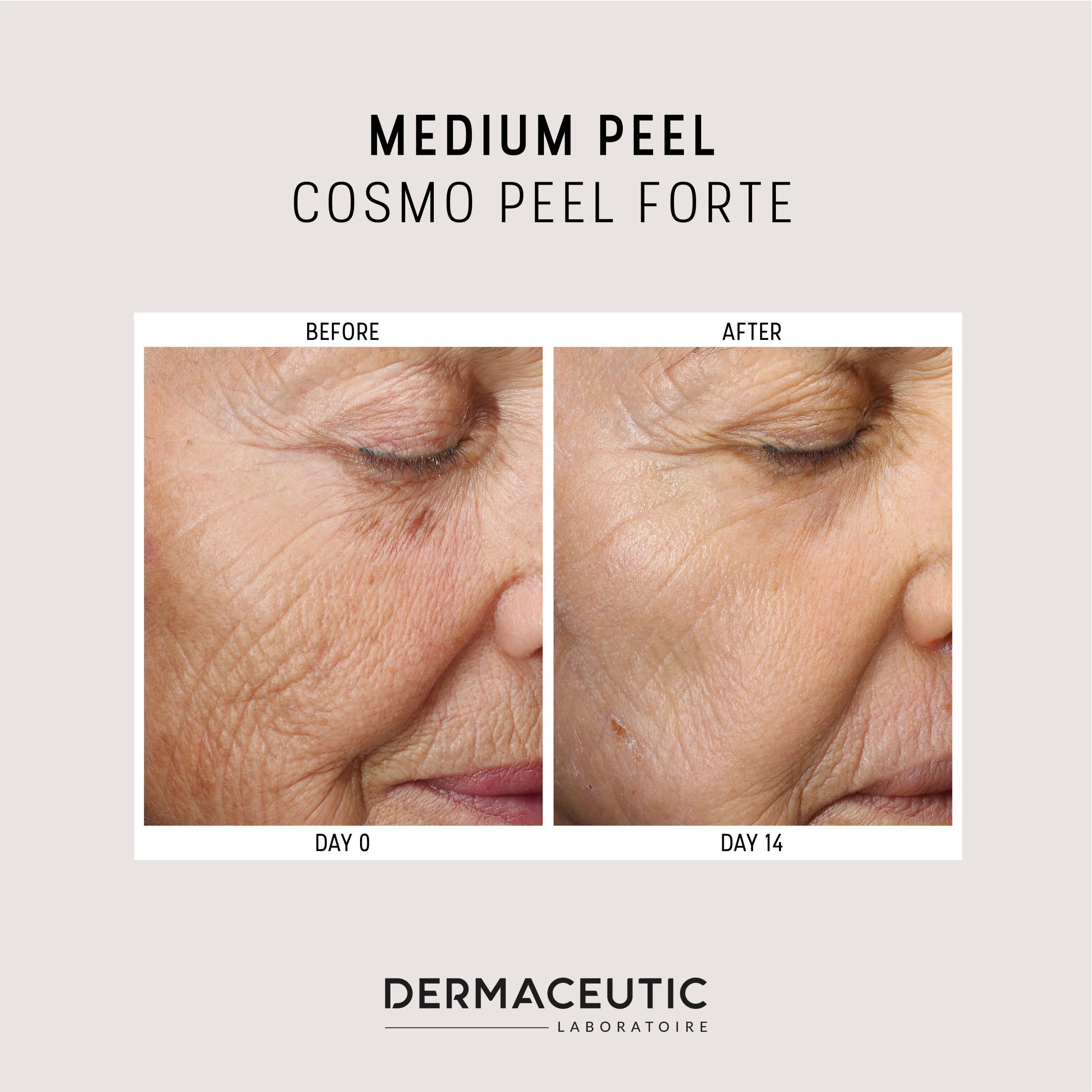 B&A Cosmo Peel Forte 1 1080x1080px 1021